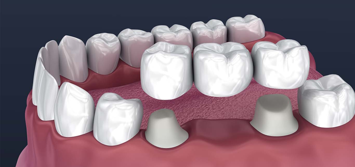 Crowns & Bridges Process